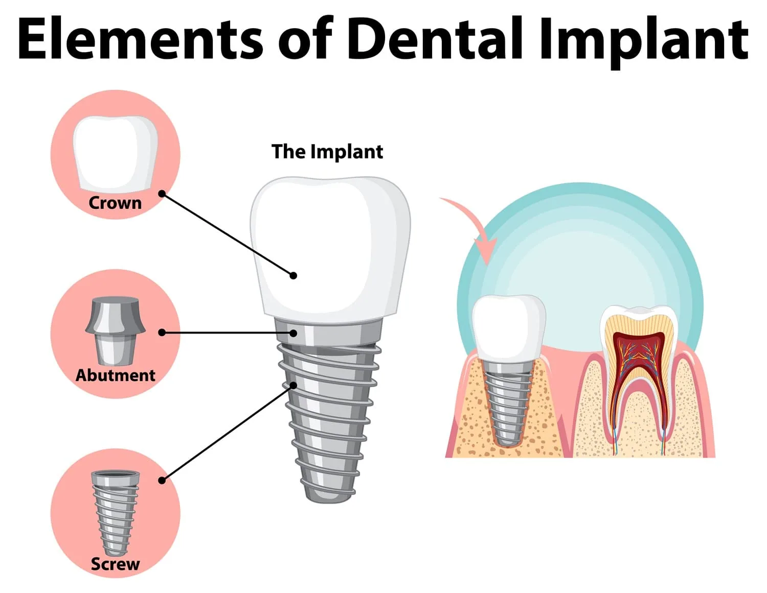 Implant restorations illustration