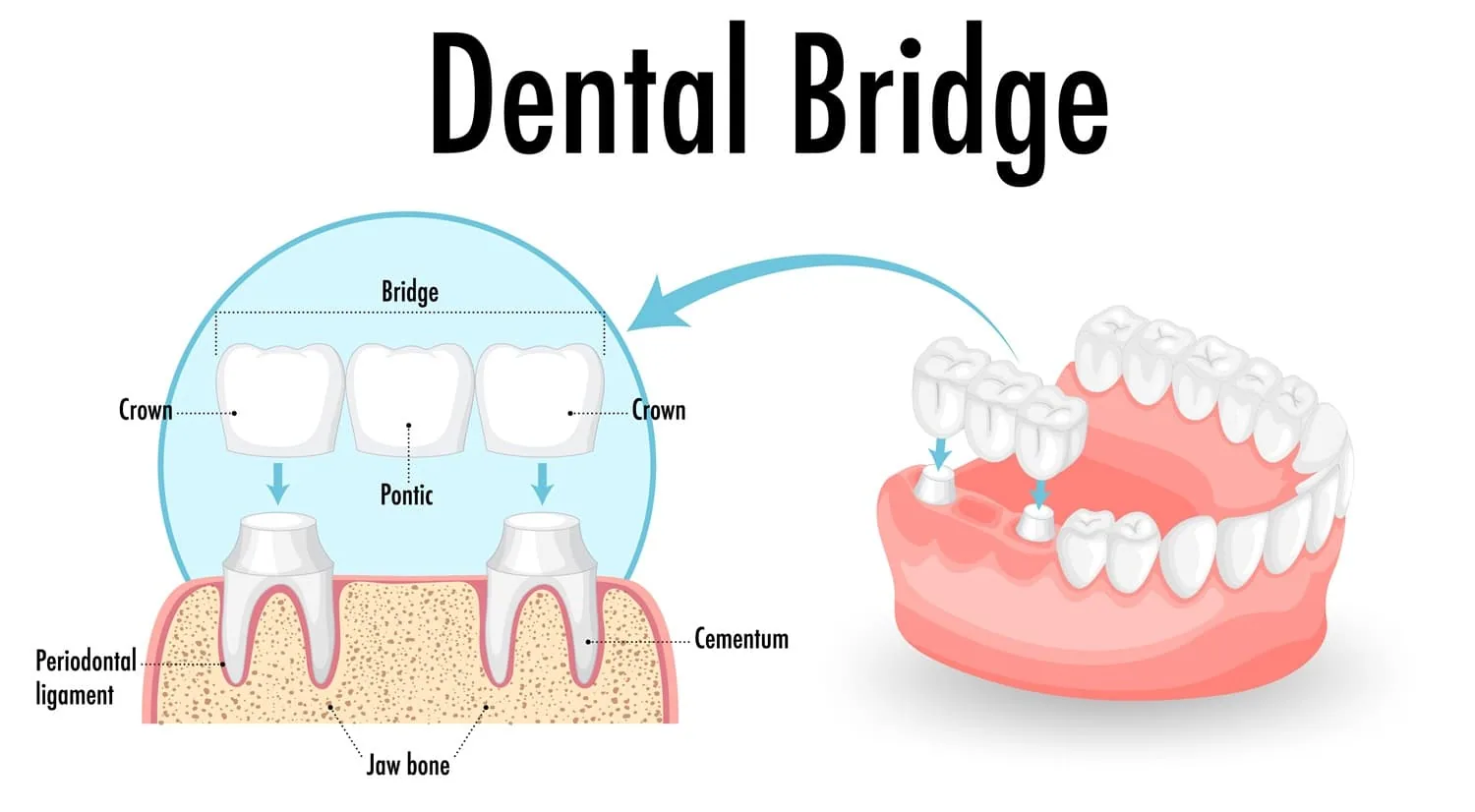 Dental bridges illustration